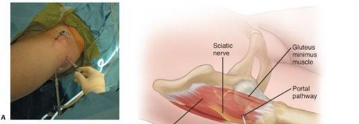 Illustration 215 for Understanding Hip Arthroscopy: The Basics Explained