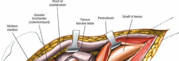 Illustration 127 for Unlocking Every Aspect of the Hip's Surgical Approaches