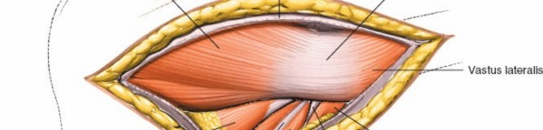 Illustration 122 for Pelvis & Acetabulum Approaches: Unlocking the Posterior Superior Iliac