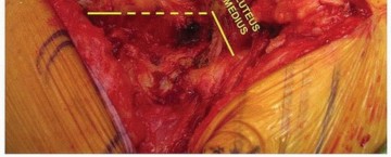 Illustration 10 for Extended Trochanteric Osteotomy: How et al Extended Revision THA Solutions