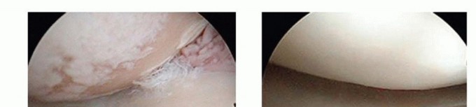 Illustration 7 for High Tibial Osteotomy: Realignment for Lasting Knee Pain Relief
