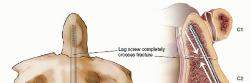 Illustration 10 for Master Techniques for Cervical Fracture Reduction: Type III & More
