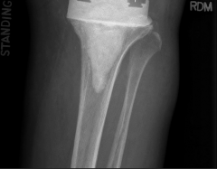 Illustration 36 for PROSTALAC Articulating Spacer: Treat Infected Knees, Regain Mobility