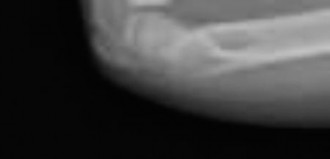 Illustration 4 for Pediatric Buckle Fracture: When is a Velcro Wrist Brace Best?