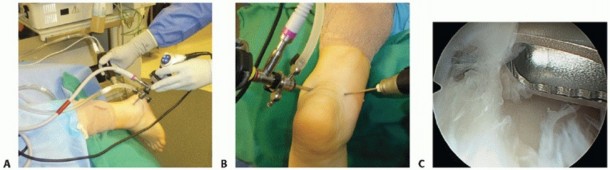 Subtalar Arthroscopy: Solving the Mystery of Sinus Tarsi Syndrome