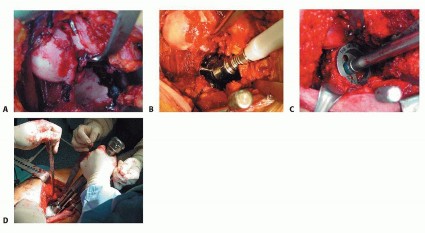 Illustration 6 for Hip Resurfacing: The Bone-Sparing Solution around the Femoral Head