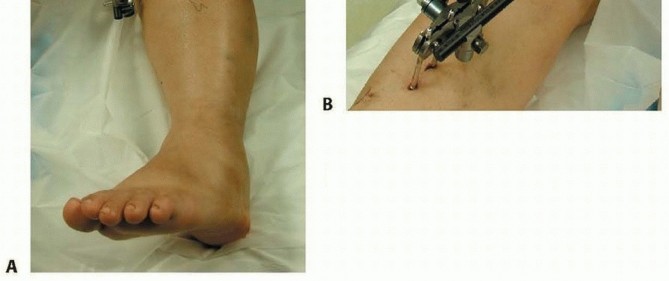 Illustration 40 for Repairing Distal Femur Fractures: Open Reduction & Internal Fixation
