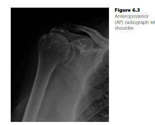 Candidate: Can you interpret this anteroposterior shoulder X-ray?