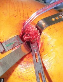 Illustration 47 for Exploring the Ambulatory Surgical Setting for Total Hip Replacement