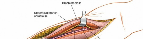 Illustration 9 for Mastering Approaches to the Upper Third of the Radius
