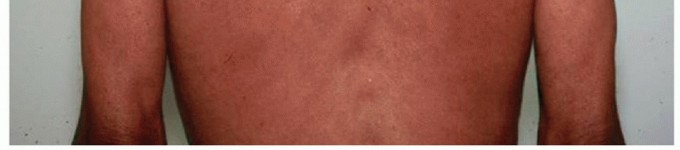 Illustration 6 for Decompressing the Transverse Scapular Ligament for Shoulder Pain Relief