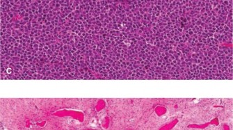 Illustration 6 for Diagnostic Dilemma: Unpacking Oncology Cases Enchondroma