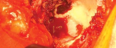 Illustration 15 for Posterolateral Surgical Approaches: Achieve Optimal Hip Replacement