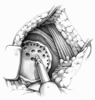 Illustration 4 for Cemented Acetabular Component: Achieving Optimal THA Stability