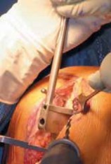 Illustration 15 for Knee Arthroplasty Unicondylar: Discover if Partial Knee Replacement is Right