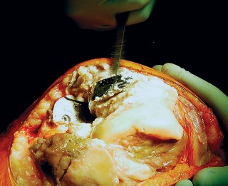 صورة طبية: مراجعة استبدال الركبة الجزئي الفاشل دليلك الشامل للعلاج الناجح في صنعاء