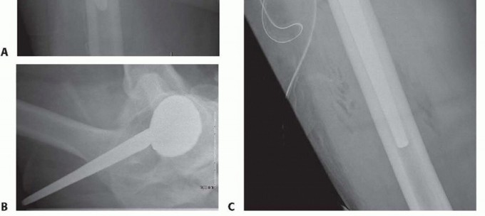Illustration 16 for Total Hip Arthroplasty: Journey to Preventing Complications
