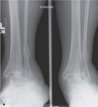 Illustration 3 for Foot & Ankle Pain: When radiographs are obtained, what do they reveal?
