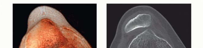 Deepening Trochleoplasty: Precision Targeting the Anterior Femoral Cortex