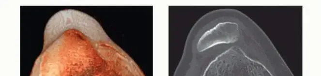 عملية تعميق البكرة الفخذية: دليل شامل لمرضى خلع الرضفة المتكرر مع الأستاذ الدكتور محمد هطيف