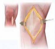 Illustration 21 for Guide Pin Assembly: Key to Flawless Upper Tibial Osteotomy
