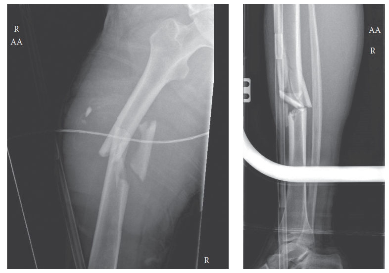 Floating Knee: Essential Management From ED to Definitive Repair