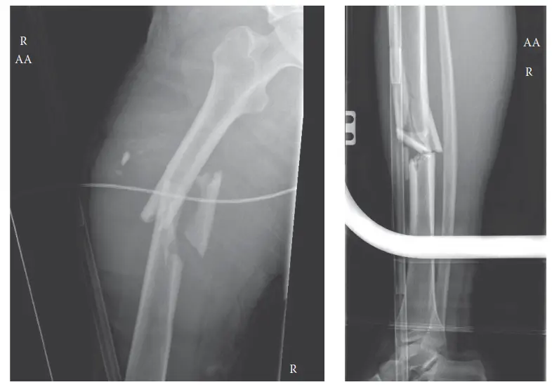 صورة توضيحية لـ إصابات الركبة العائمة: دليل شامل للمرضى من التشخيص إلى التعافي
