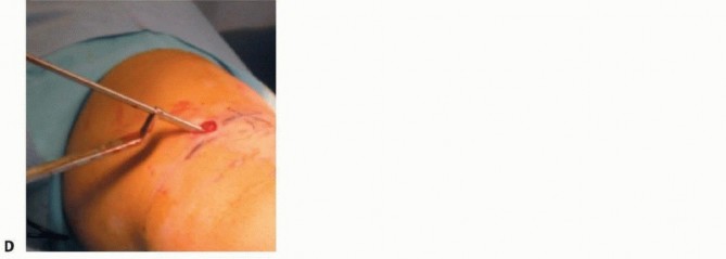 Illustration 11 for Optimal Treatment for Pediatric Tibial Fractures: Key Insights