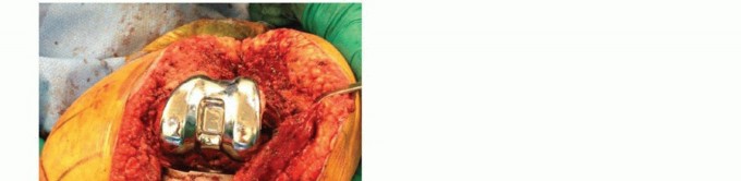 Illustration 21 for Femoral Bone Loss: Metal Augments for Revision Knee Success