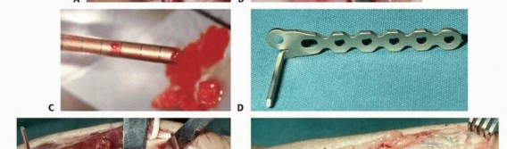 Illustration 18 for Precision Correction for Distal Radius Malunion
