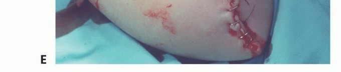 Illustration 28 for Above-Elbow & Below-Elbow Amputations: When & Why They're Needed