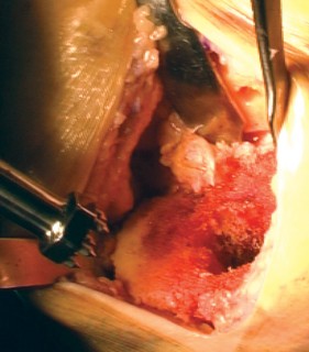 Illustration 26 for Cemented TKA Figure: Your Visual Guide to Surgical Success