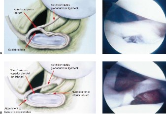 Illustration 3 for SLAP Tears: Your Guide to Diagnosis & Treatment in Elbow Cases