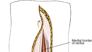 Illustration 84 for Approach to the Lumbar Spine: Mastering Techniques & Anatomy