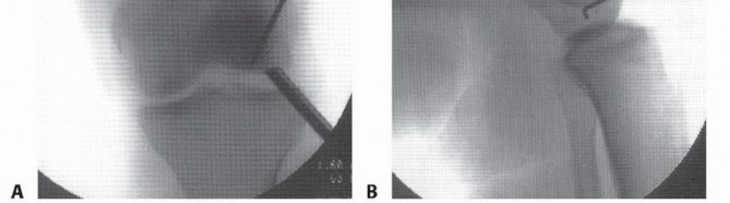 Illustration 38 for Dissecans of the Knee: What's the Difference – OCD vs. AVN?