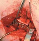 Illustration 23 for Increased Femoral Anteversion: A Proximal Femoral Rotational Osteotomy