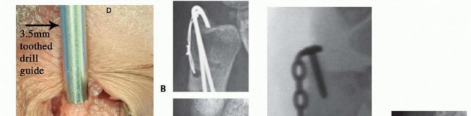 Illustration 21 for Galeazzi DRUJ Stabilization: Unlocking Stability with Smooth Stainless Steel