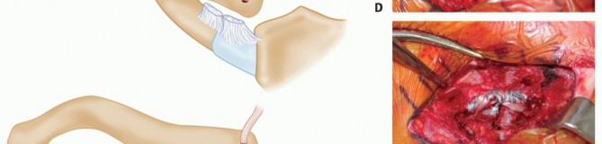Illustration 25 for Optimizing SC Dislocation Repair After Medial Clavicle Resection