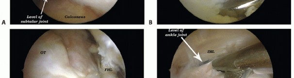 Illustration 18 for Posterior Talar Process: Endoscopic Solutions for Ankle Pain