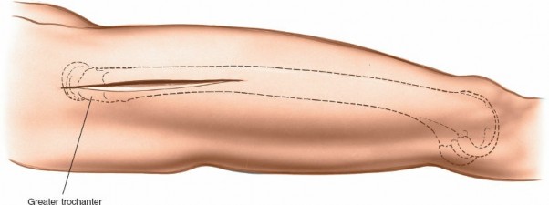 Illustration 4 for Optimal Femoral Approaches: Mastering the Lateral Intermuscular Septum