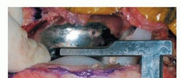 Illustration 14 for Correcting Stiffness in Revision TKA: Achieve Appropriate External Rotation