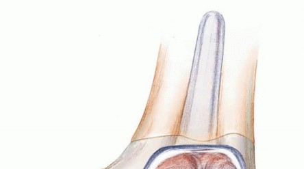 Illustration 9 for Optimizing Revision Femoral Component with Distal Femoral Bone Loss