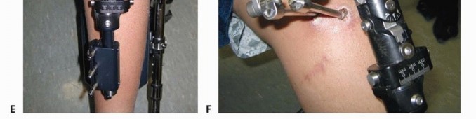 Illustration 12 for Solving Infantile Blount Disease: Surgical Management Strategies