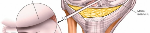 Illustration 16 for Mastering Knee Approaches: Spotlight on Superficial Medial Ligament