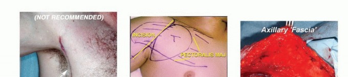 Illustration 12 for Axillary Space Exploration: Surgical Resection of Complex Tumors