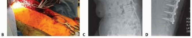 Illustration 34 for Duchenne Muscular Dystrophy: Is Spinal Fusion the Answer?
