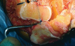 Illustration 27 for Mastering TKA: Essential Methods of Rotational Alignment