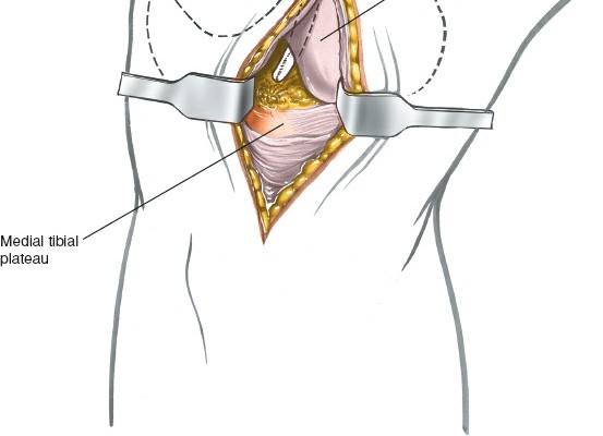 Illustration 233 for Mastering Knee Approaches: Spotlight on Superficial Medial Ligament
