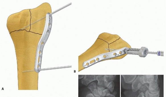 Illustration 35 for Fragment-Specific Fixation: Restore Carpal Facet Horizon