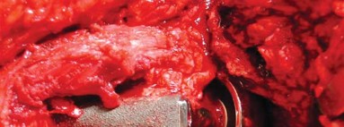 Illustration 18 for Management of Periprosthetic Fractures: An Expert Surgical Guide